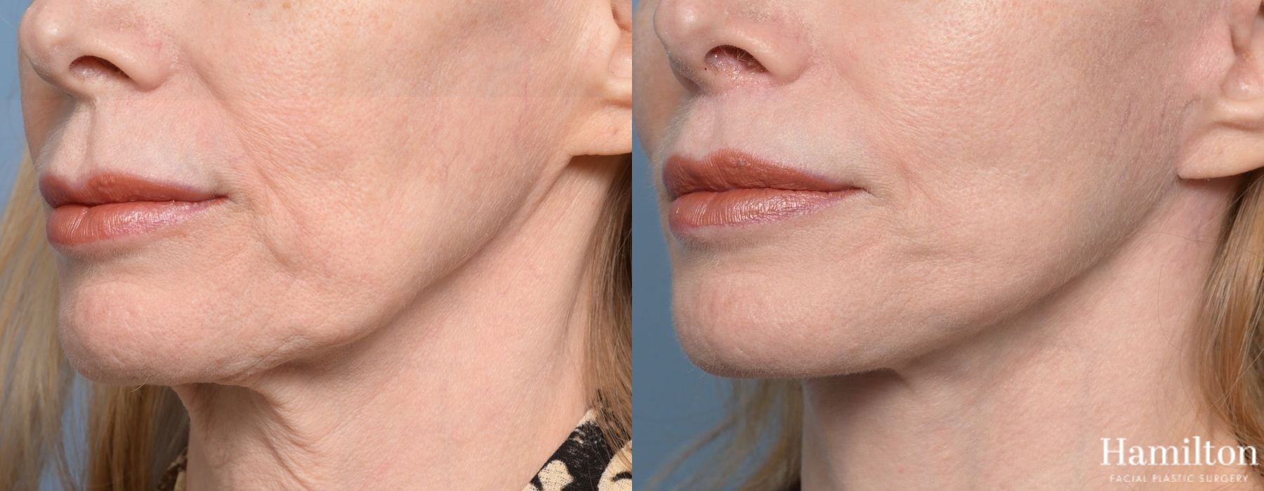 Before and after Lip Lift case 37100 - Angle 3