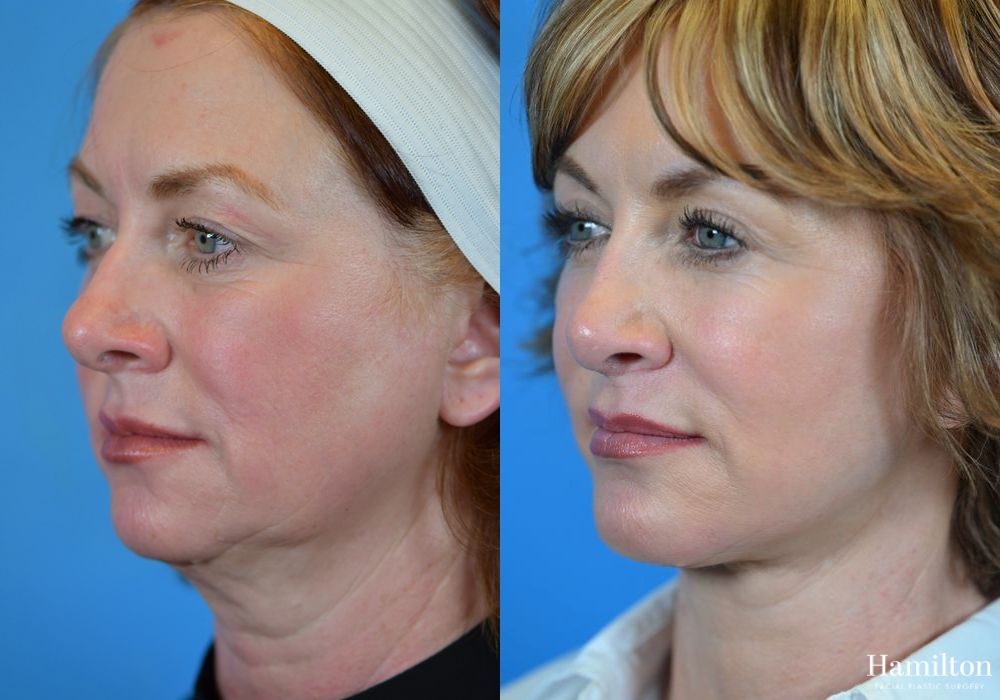 Before and after Rhinoplasty case 37318