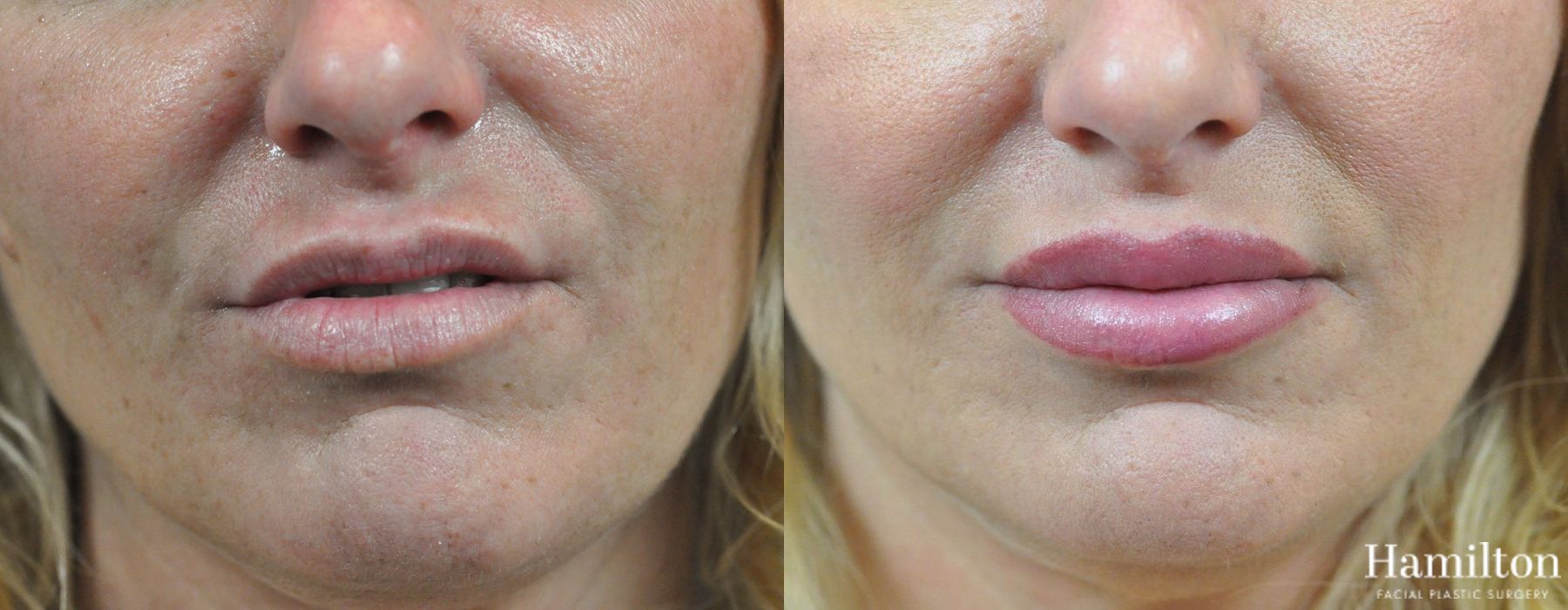 Before and after Lip Lift case 37143
