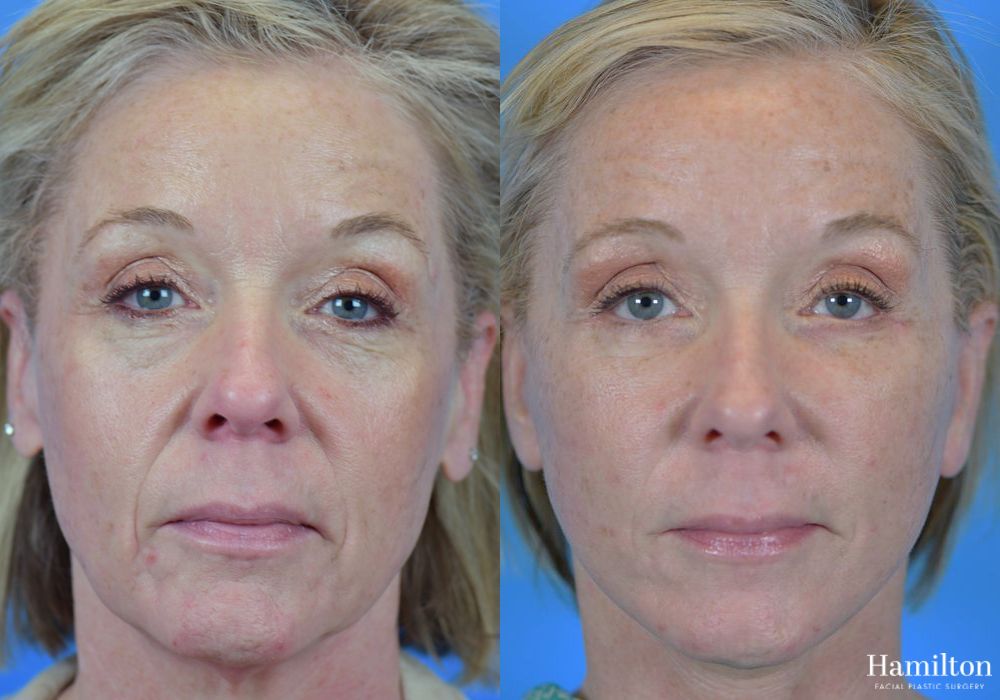 Before and after Facelift case 37316