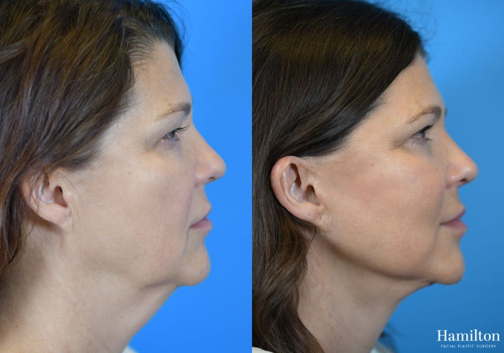 Before and after Facelift case 37254