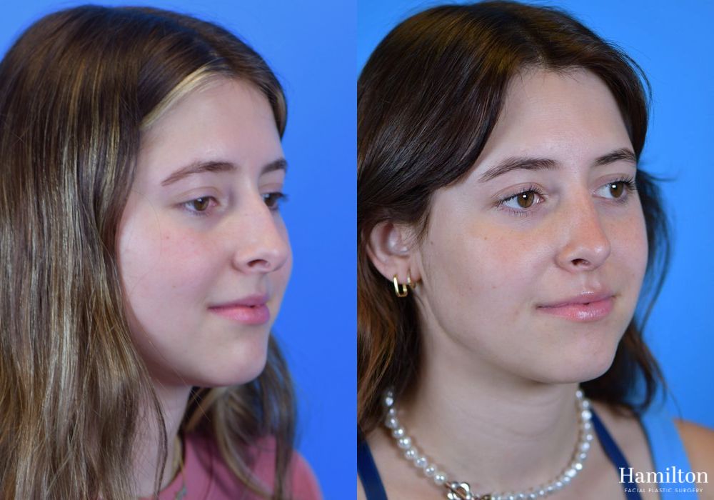 Before and after Rhinoplasty case 37336 - Angle 2