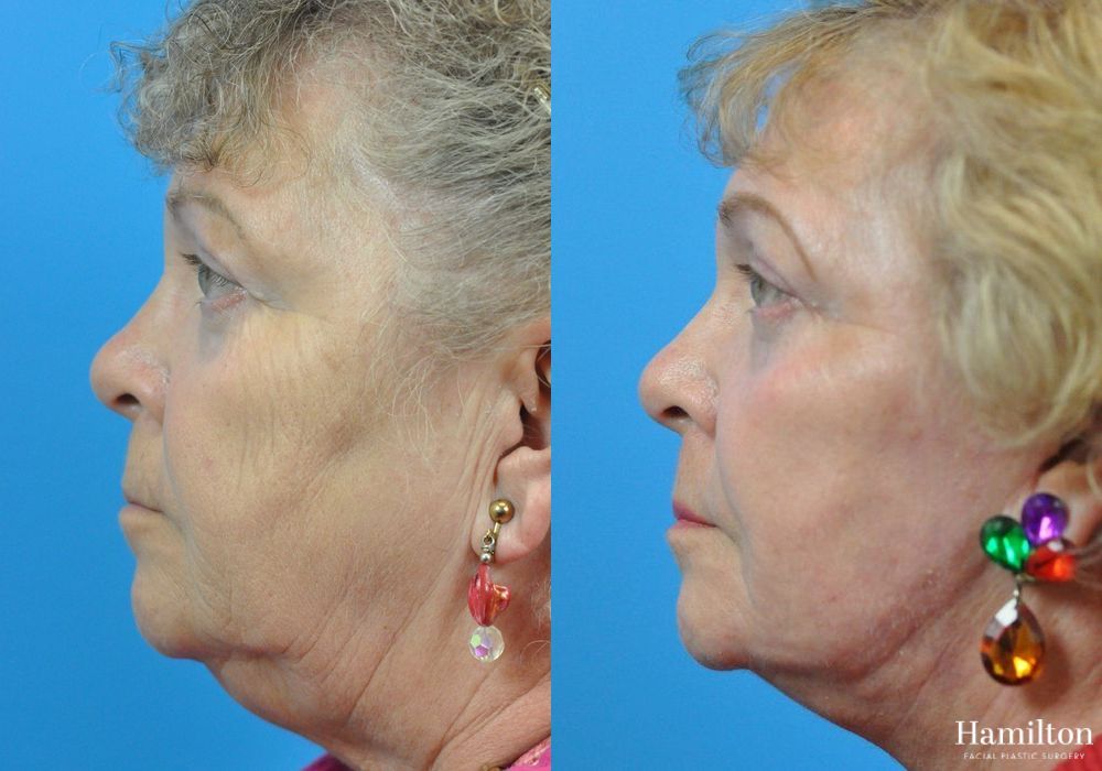 Before and after Laser - CO2 case 37210 - Angle 2