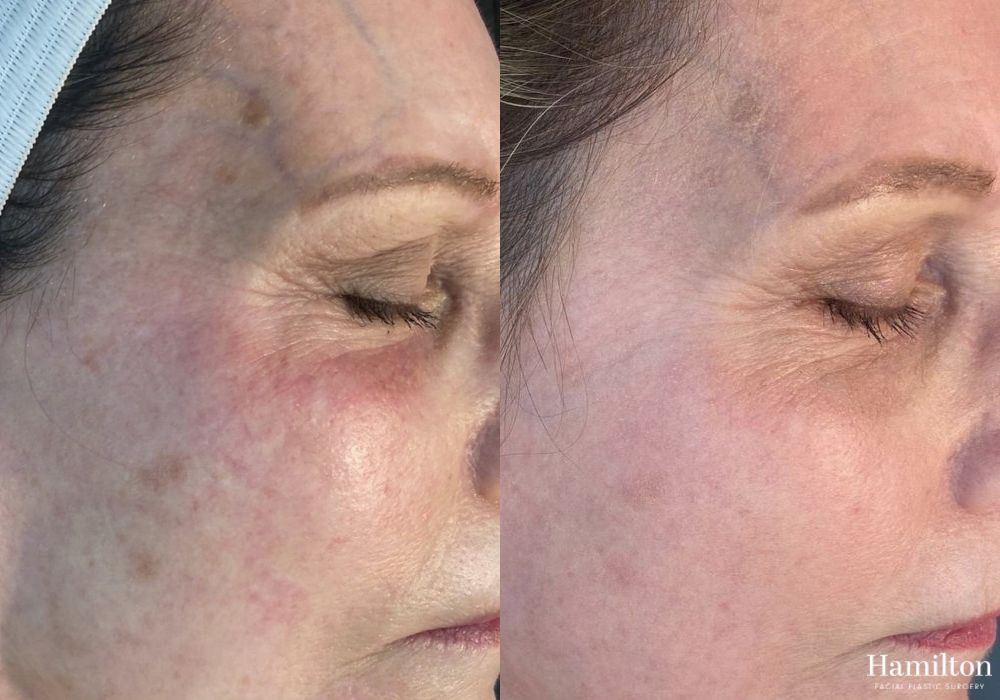 Before and after Laser - MOXI case 37340