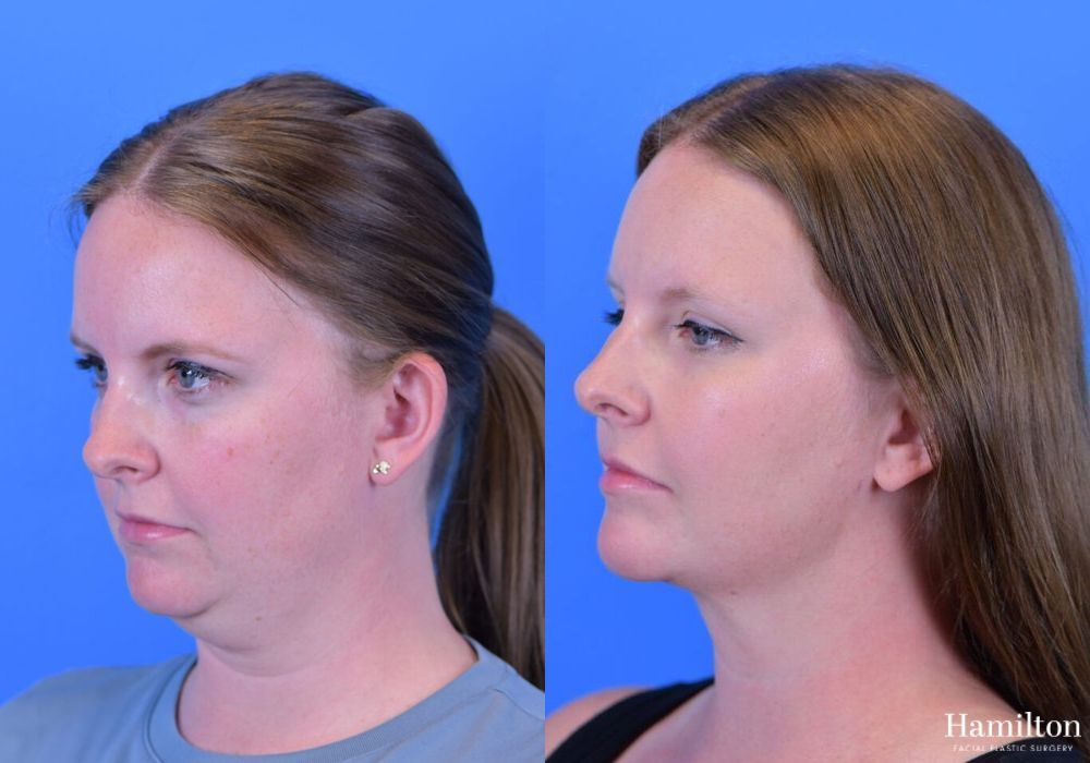 Before and after FaceTite case 37108 - Angle 2
