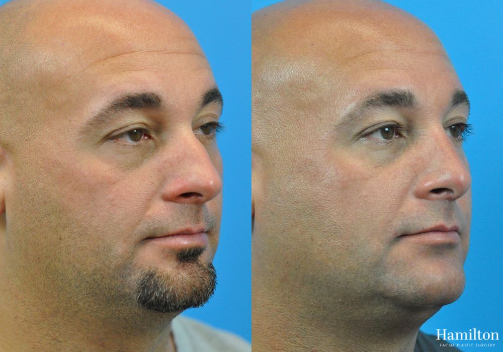 Before and after Rhinoplasty case 37255 - Angle 3