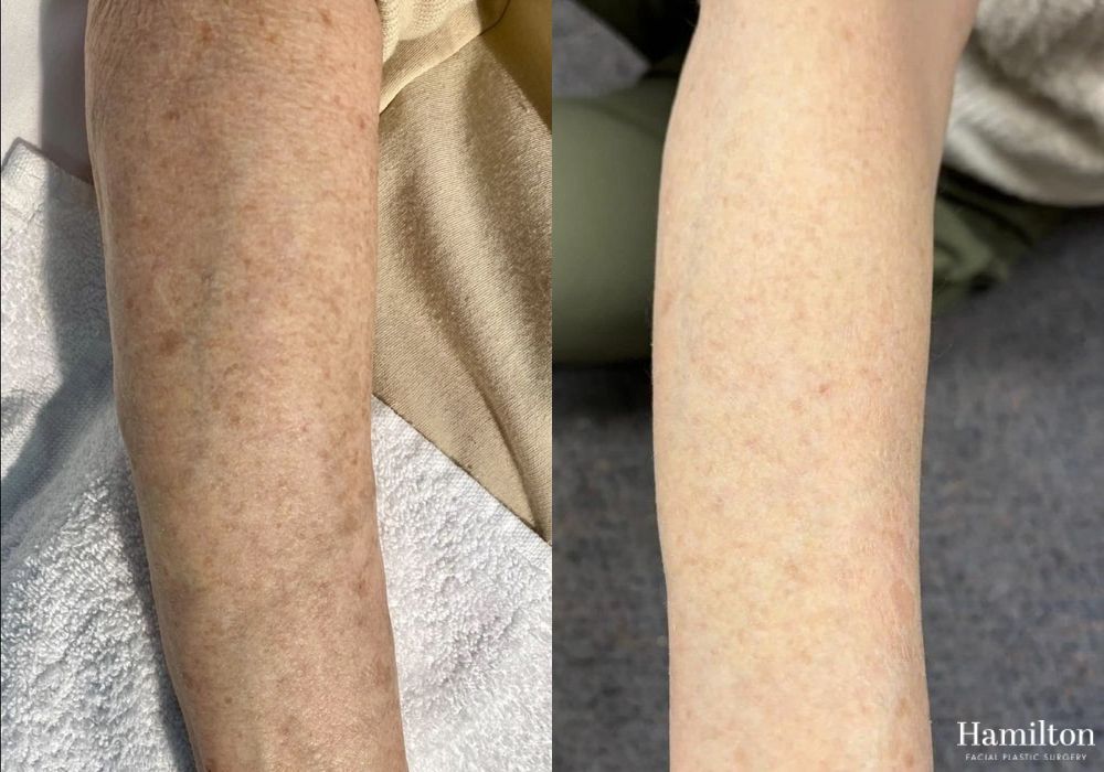 Before and after Laser - Broad Band Light (BBL) case 37104