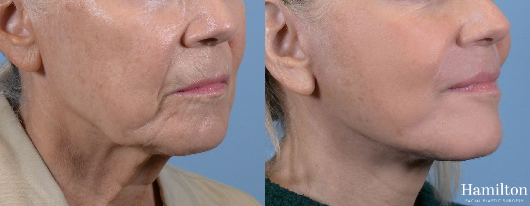 Before and after Laser - Sciton case 37089 - Angle 3