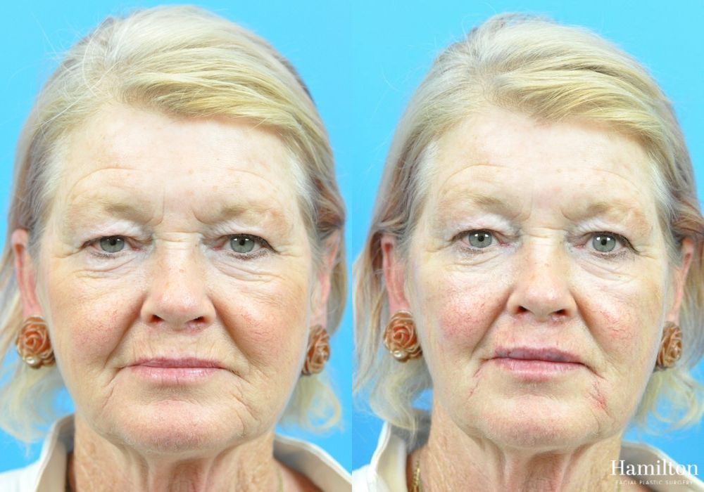 Before and after Lip Enhancement case 37242