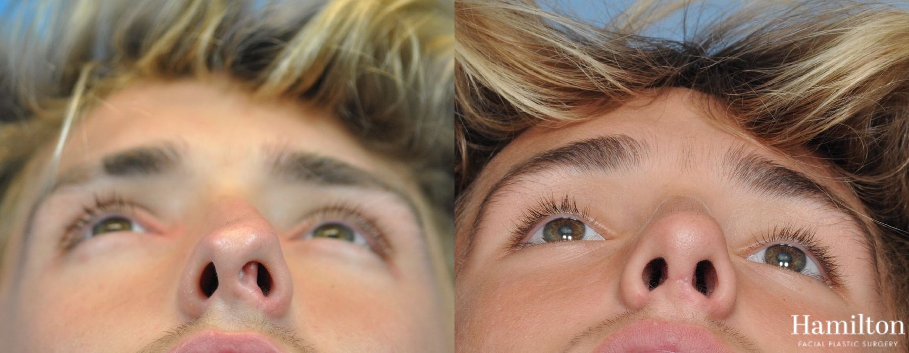 Before and after Rhinoplasty case 37244 - Angle 2