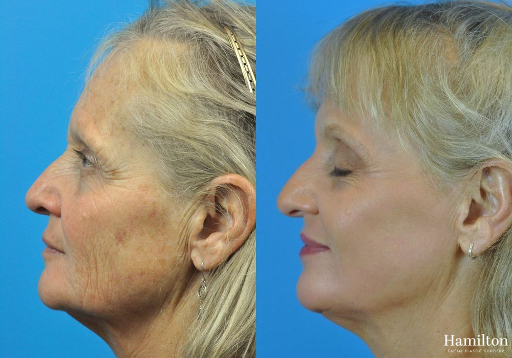 Before and after Laser - CO2 case 37091 - Angle 3
