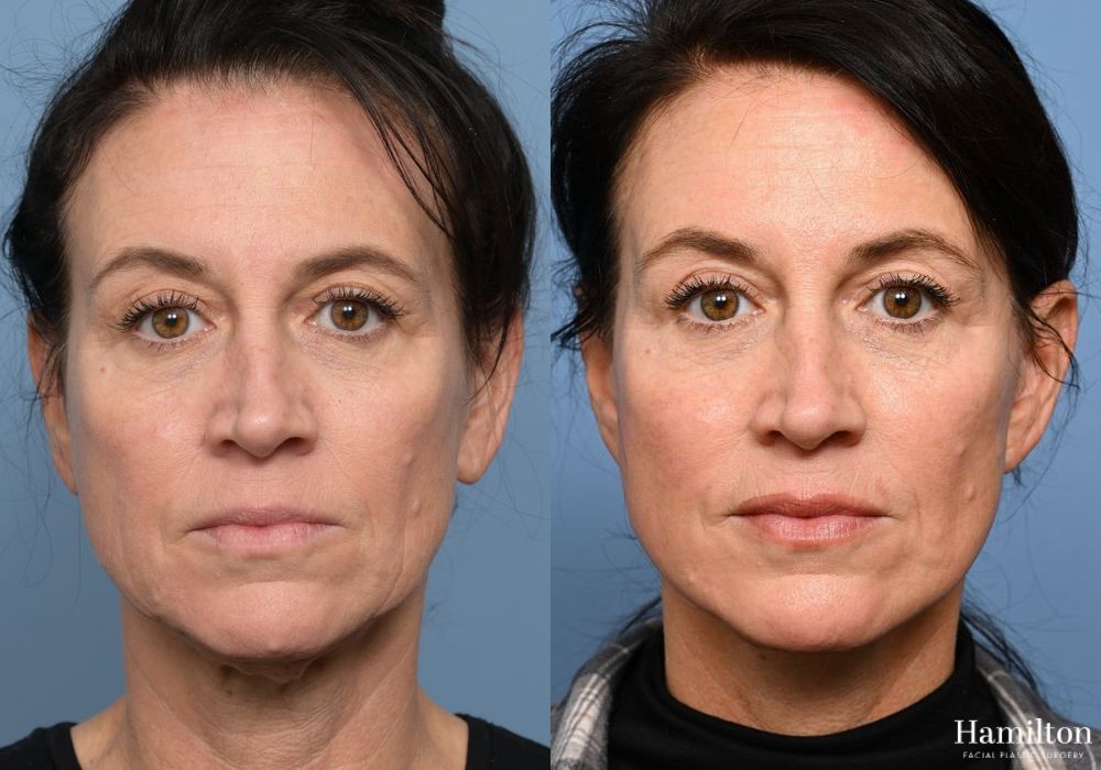 Before and after Facelift case 37315 - Angle 4