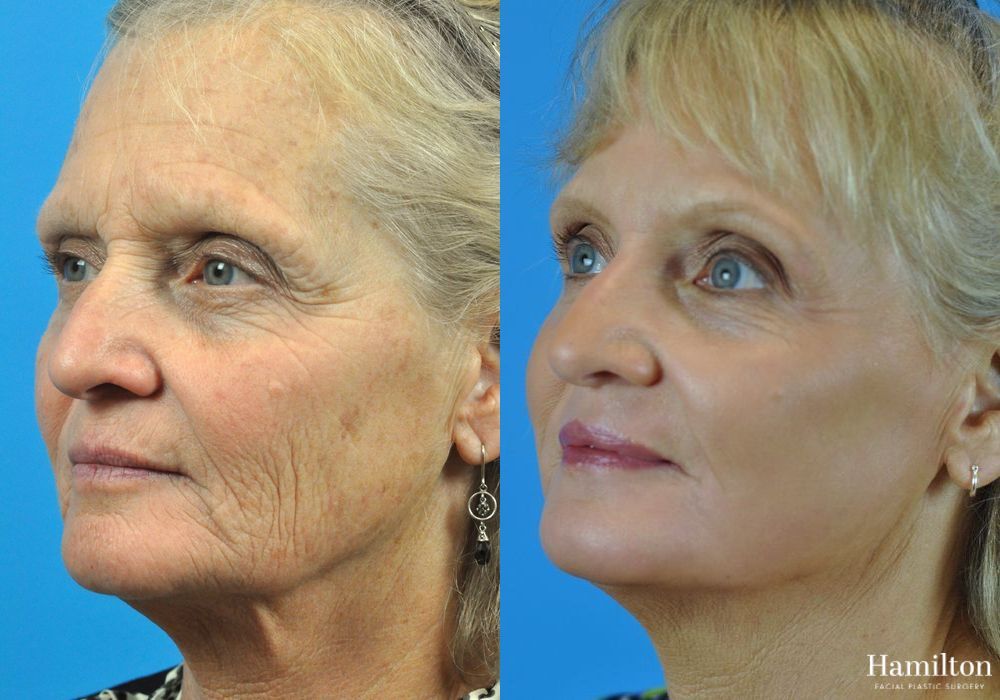 Before and after Laser - CO2 case 37091 - Angle 2