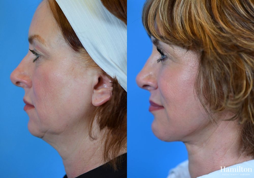 Before and after Rhinoplasty case 37318 - Angle 3