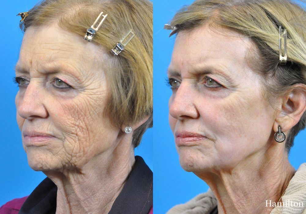 Before and after Laser - CO2 case 37170 - Angle 4