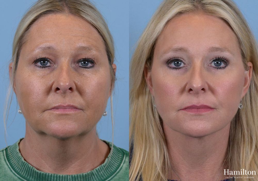 Before and after Brow Lift case 37178 - Angle 4