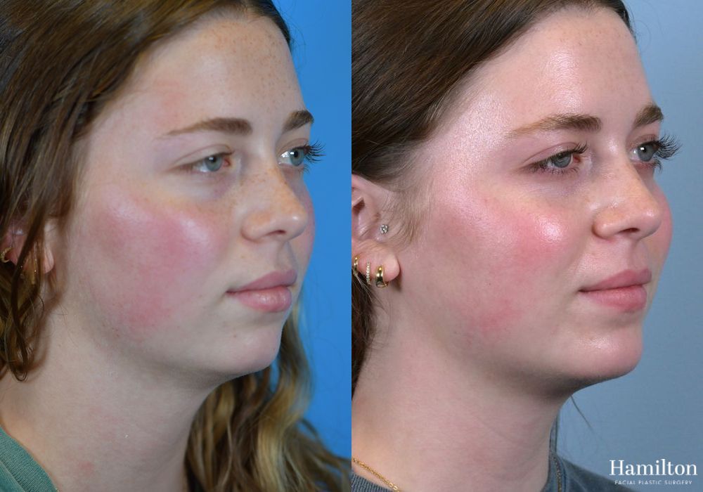 Before and after Chin Augmentation case 37176
