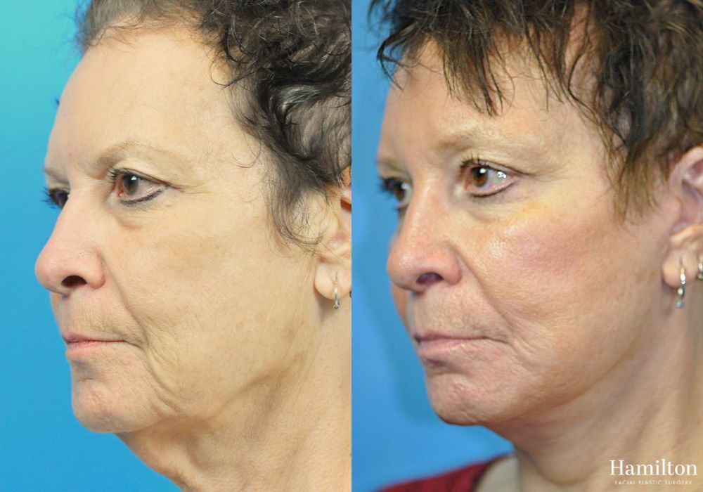 Before and after Brow Lift case 37232 - Angle 5