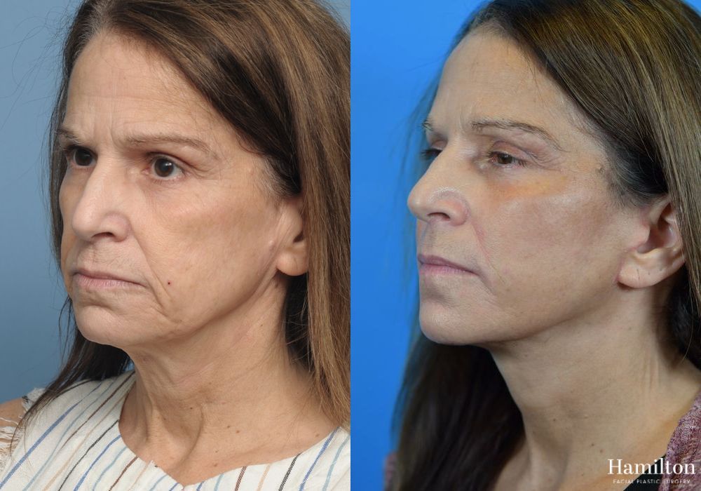 Before and after Facelift case 37273 - Angle 3