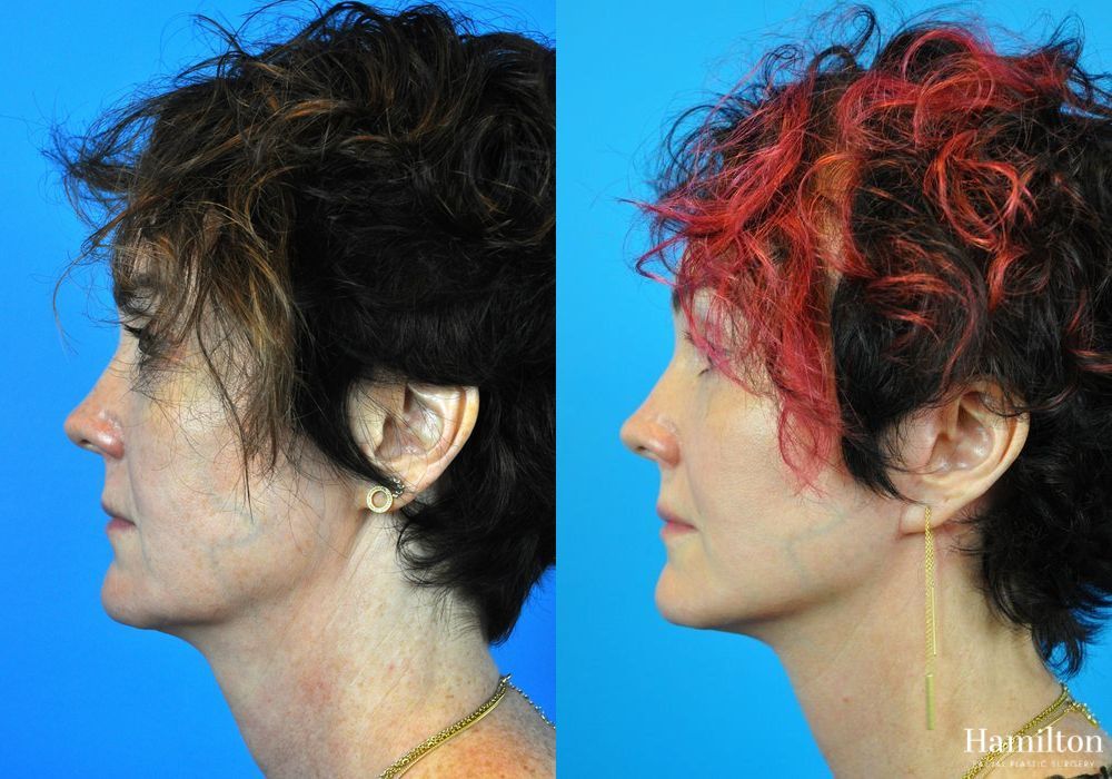 Before and after Mini Facelift case 37095