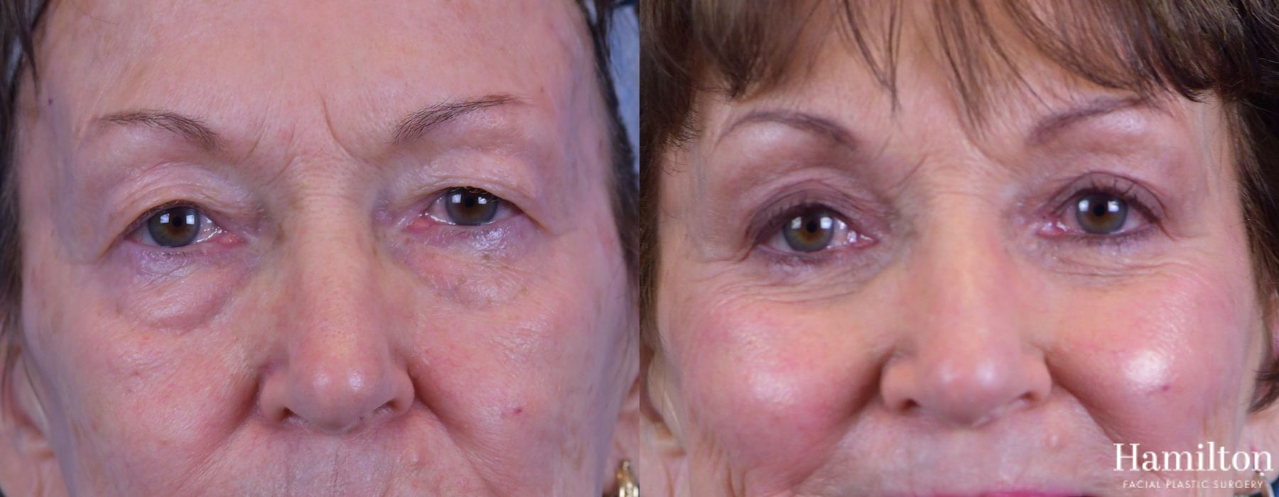 Before and after Blepharoplasty case 37297