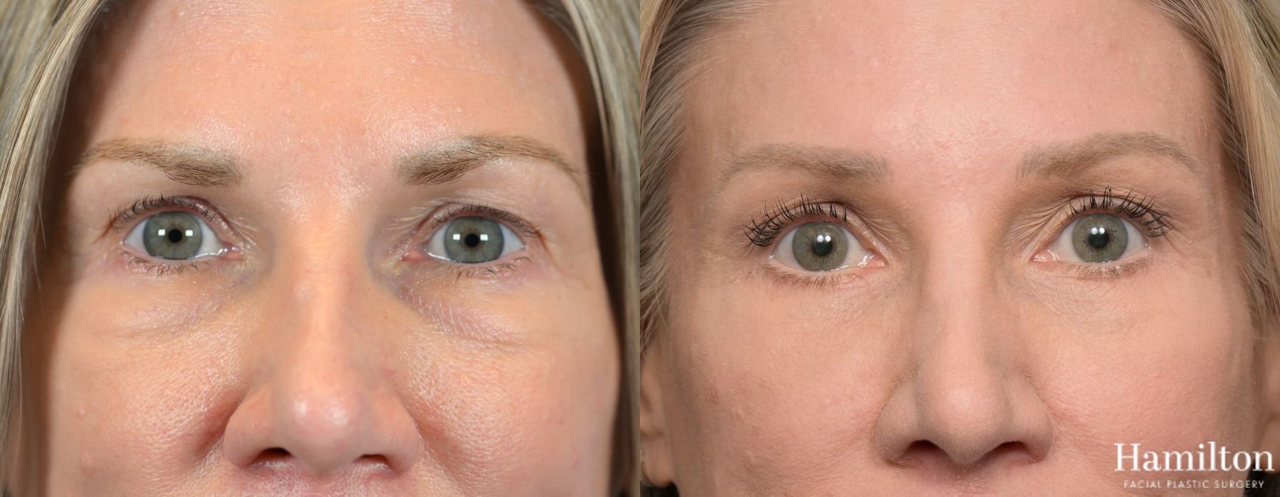 Before and after Blepharoplasty case 37257