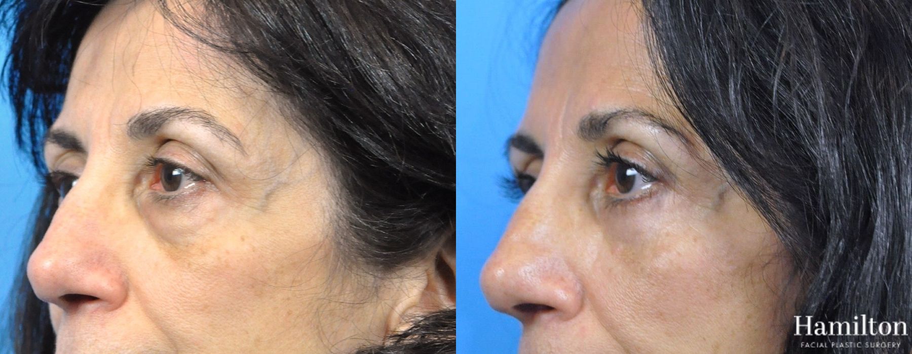 Before and after Blepharoplasty case 37262 - Angle 2