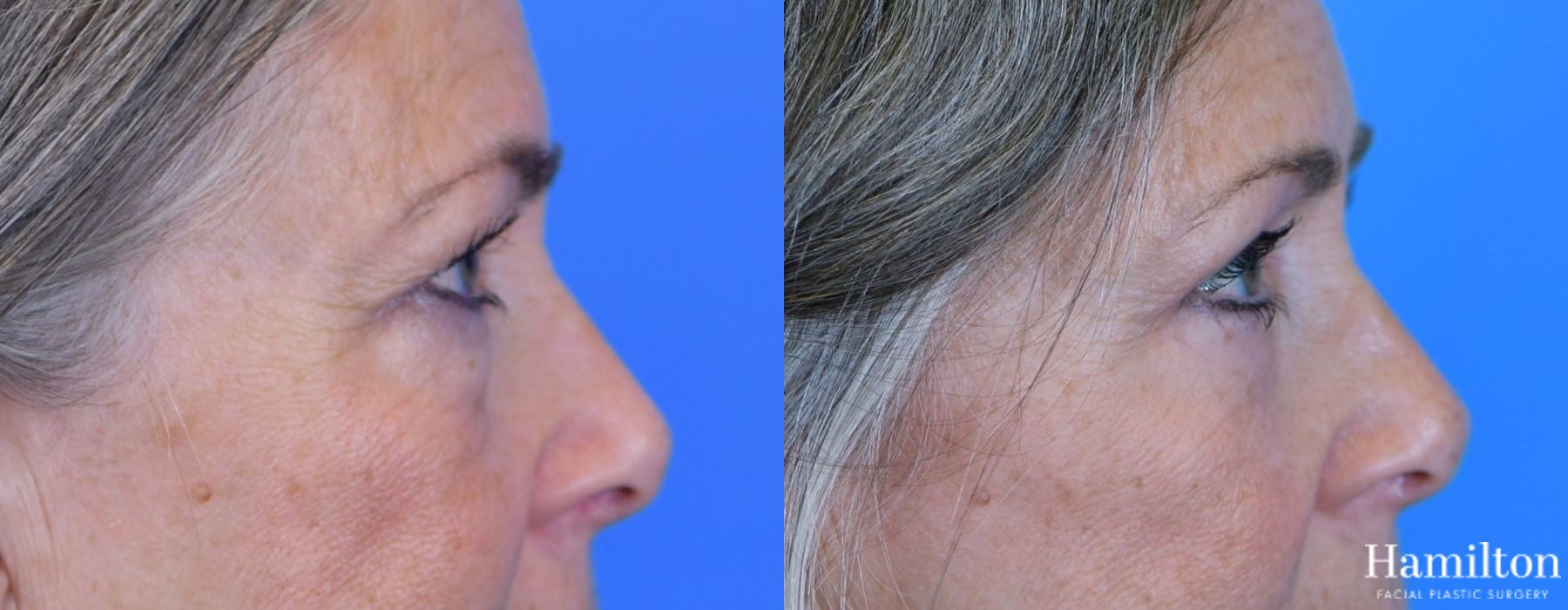 Before and after Blepharoplasty case 37267 - Angle 4