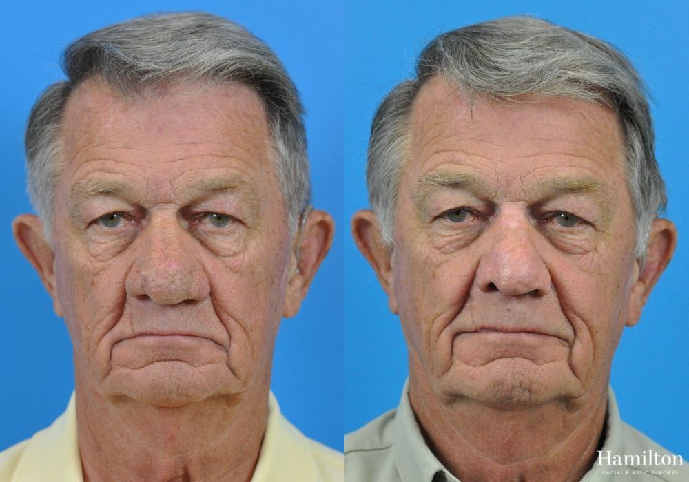 Before and after Rhinophyma case 37351 - Angle 3