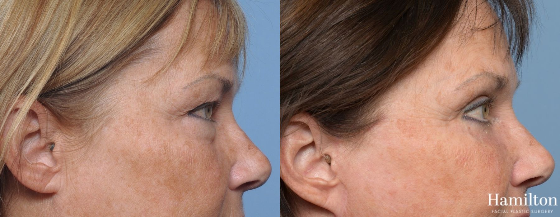 Before and after Blepharoplasty case 37256 - Angle 4