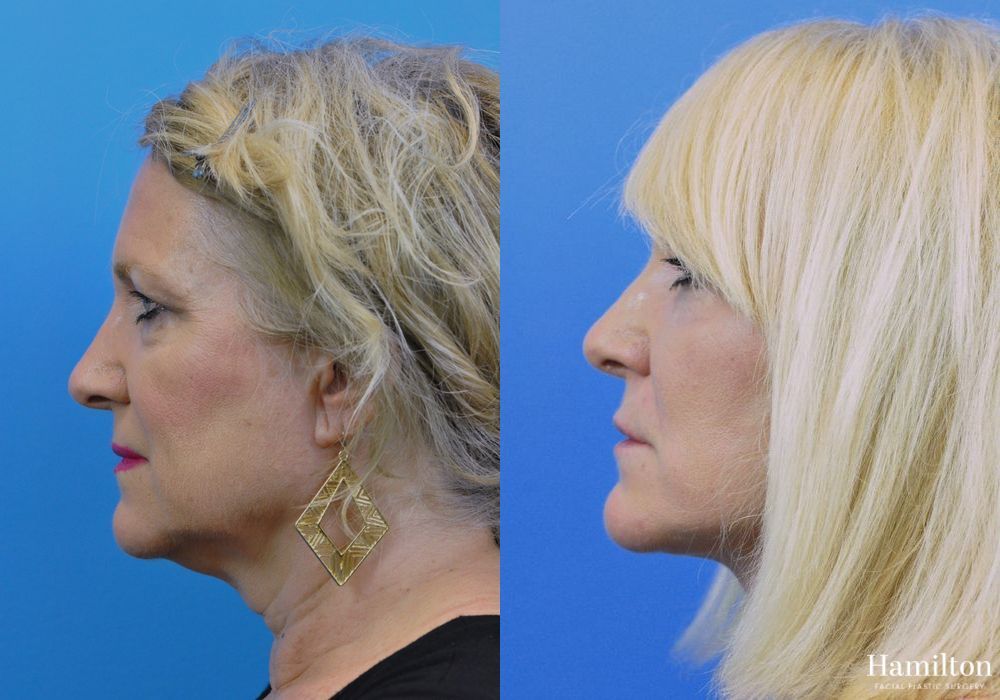 Before and after Facelift case 37266 - Angle 3
