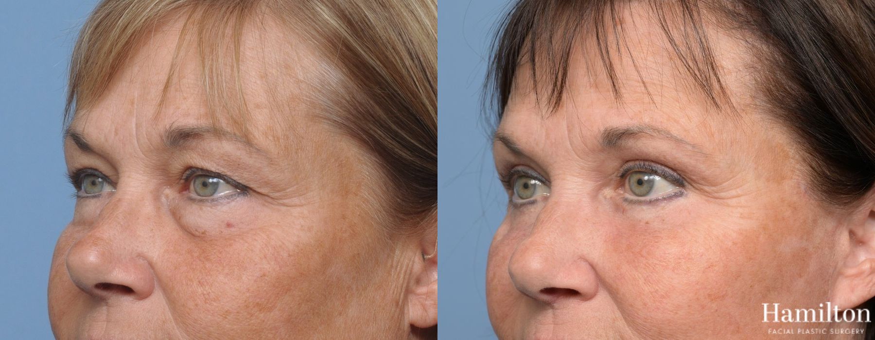Before and after Blepharoplasty case 37256 - Angle 2
