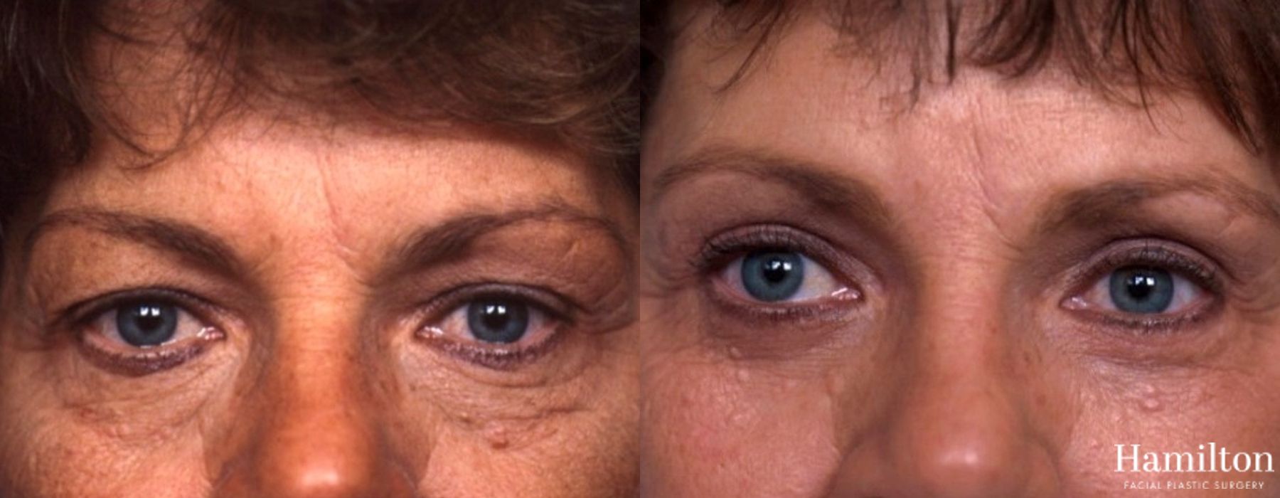 Before and after Facelift case 37324 - Angle 4