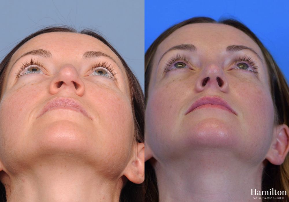 Before and after Rhinoplasty case 37199 - Angle 5