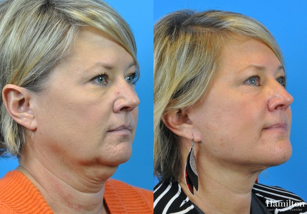 Before and after Neck Rejuvenation case 37172 - Angle 4