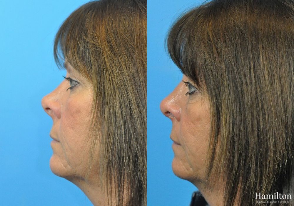 Before and after Rhinoplasty case 37346 - Angle 2