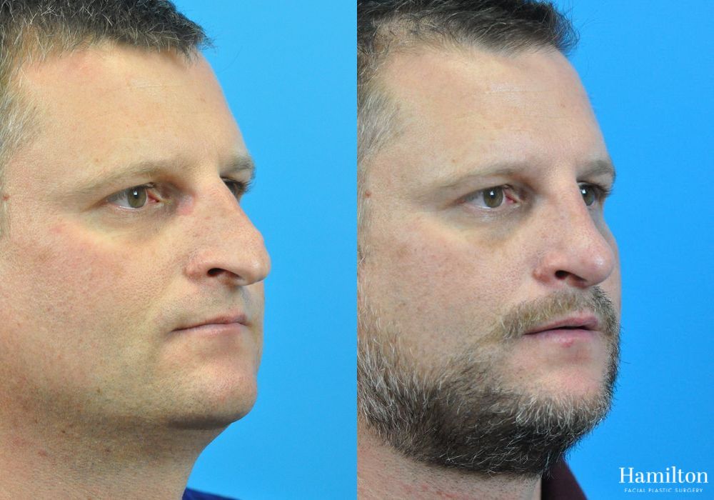 Before and after Rhinoplasty case 37312 - Angle 4