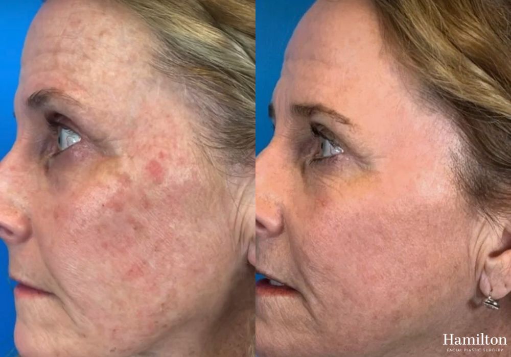 Before and after Laser - Broad Band Light (BBL) case 37161