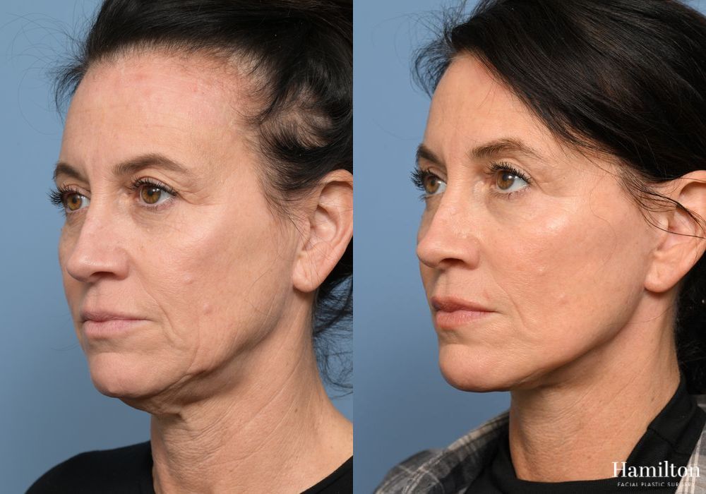 Before and after Facelift case 37315