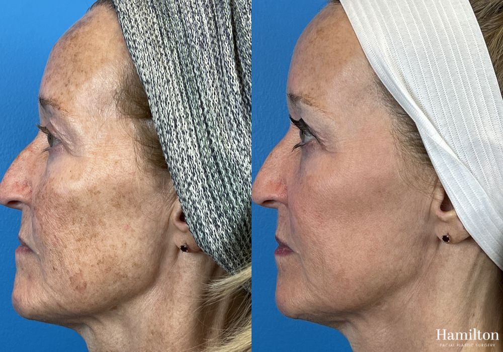 Before and after Laser - Broad Band Light (BBL) case 37099