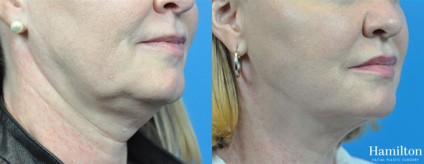 Before and after FaceTite case 37148 - Angle 2