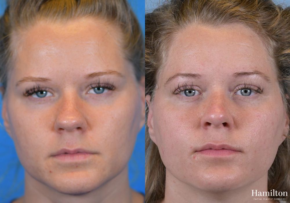 Before and after Rhinoplasty case 37359 - Angle 5