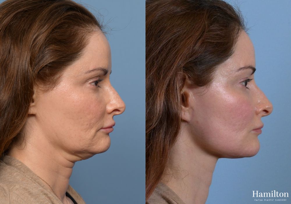 Before and after Neck Rejuvenation case 37096