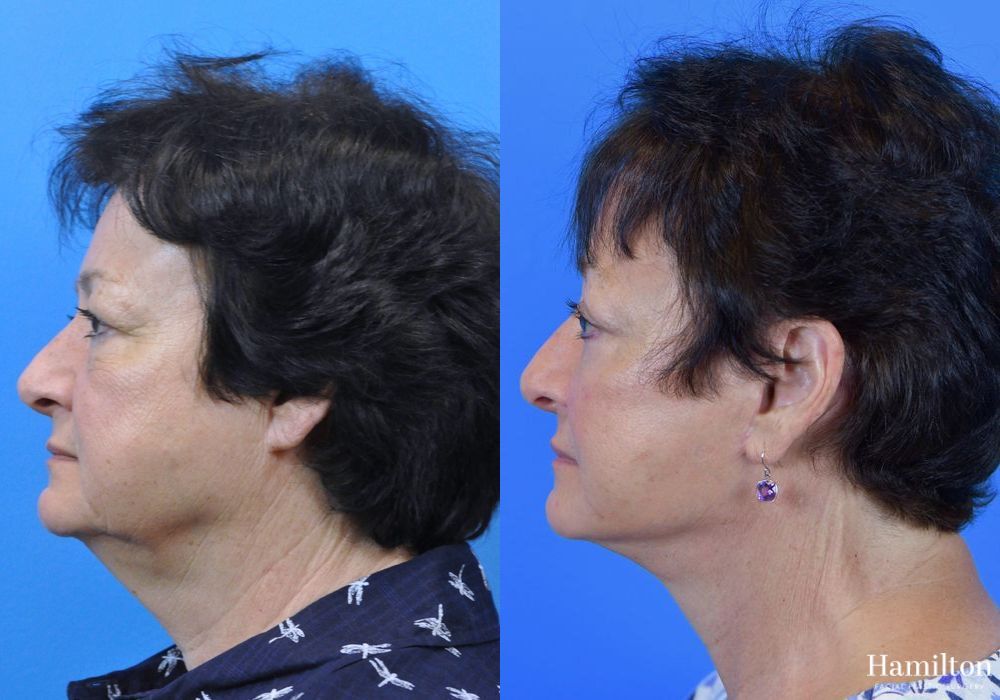 Before and after Facelift case 37296