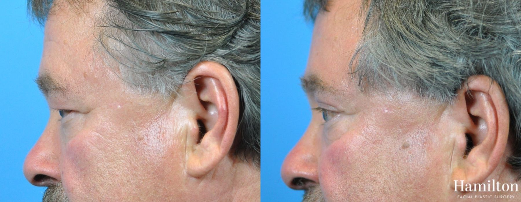 Before and after Blepharoplasty case 37319 - Angle 6