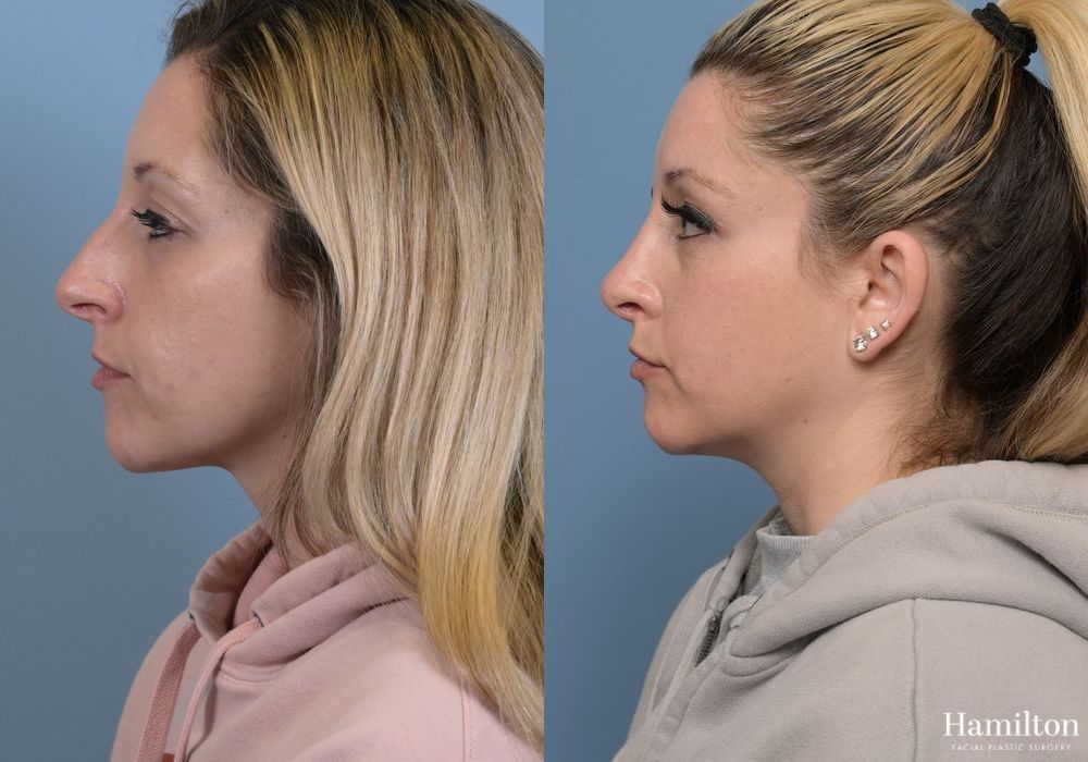 Before and after Rhinoplasty case 37239
