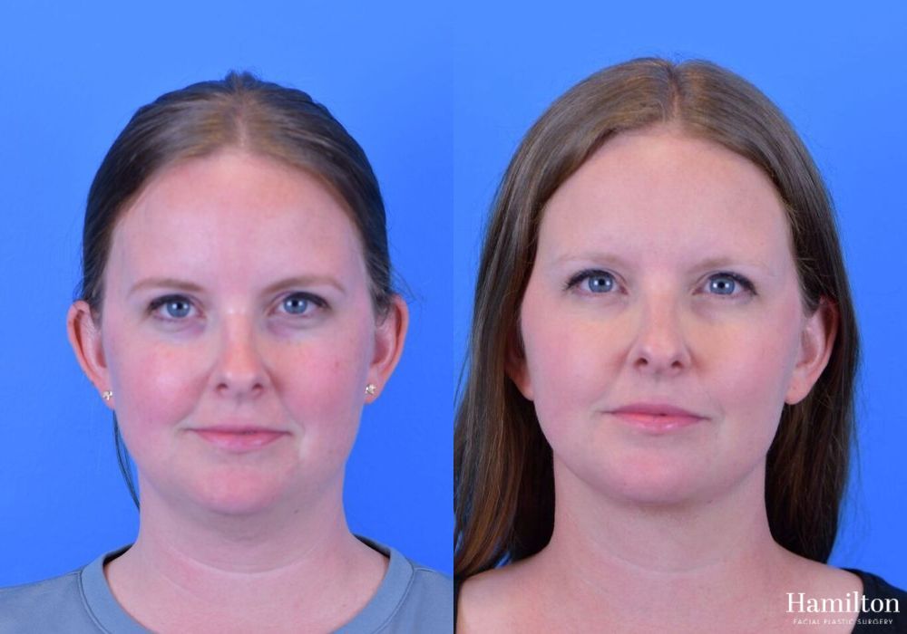 Before and after FaceTite case 37108