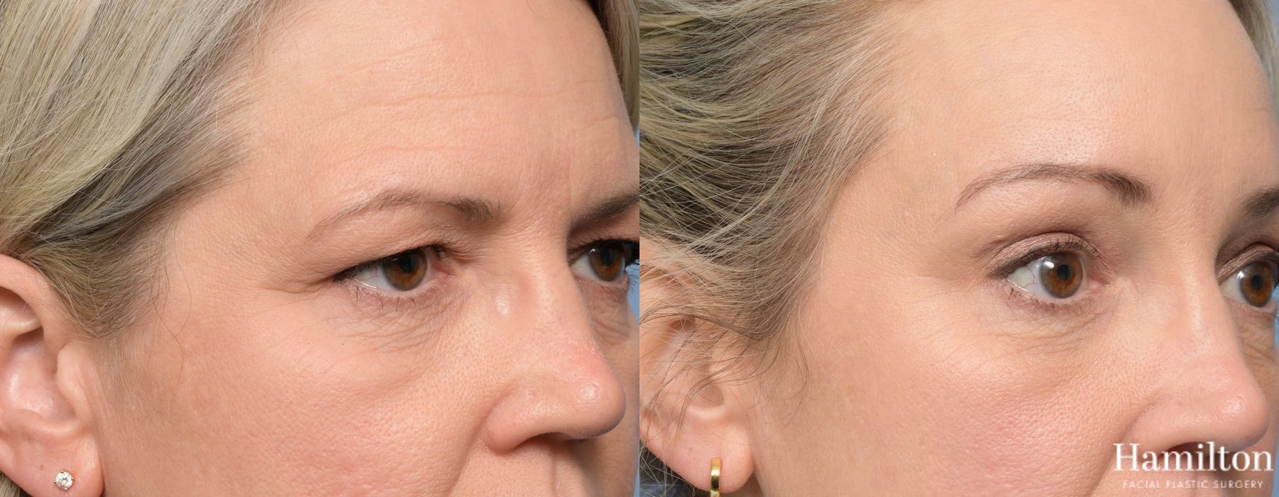 Before and after Blepharoplasty case 37175 - Angle 5