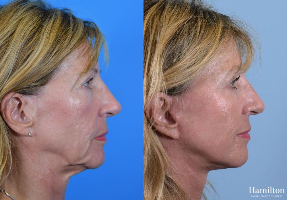 Before and after Facelift case 37279 - Angle 2