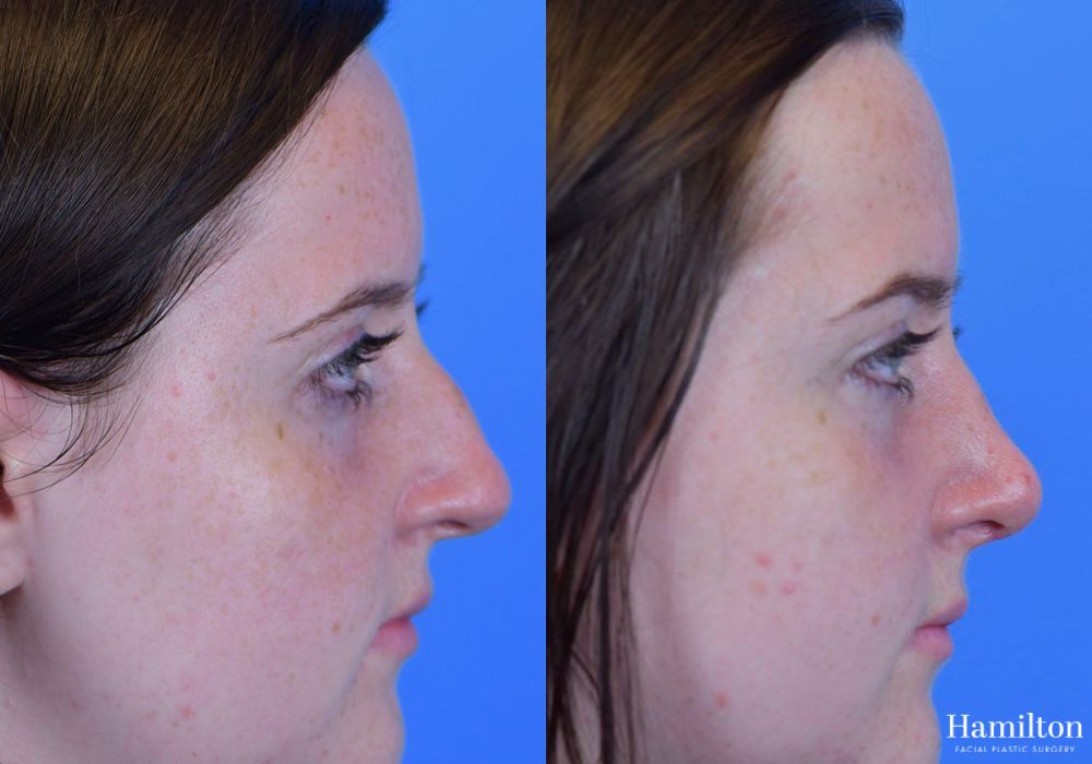 Before and after Rhinoplasty case 37339 - Angle 2